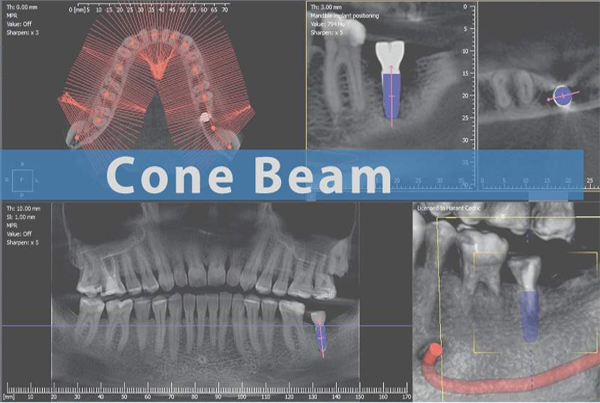 CBCT