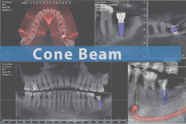 CBCT