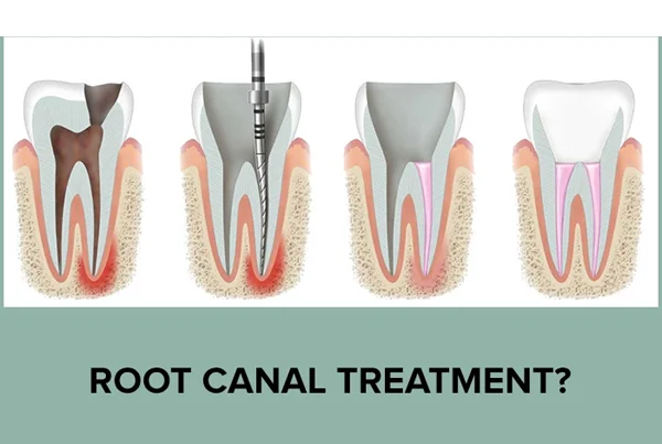 Root Canal Treatment
