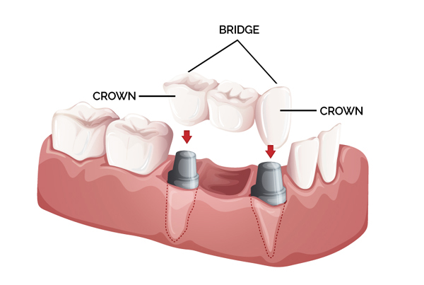 Crown and Bridges