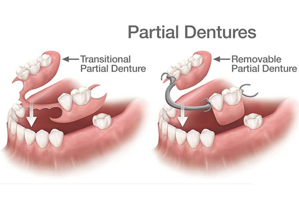 Partial Denture