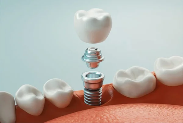 Implants