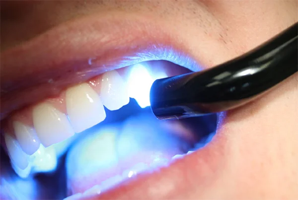 Light Cure Composite
