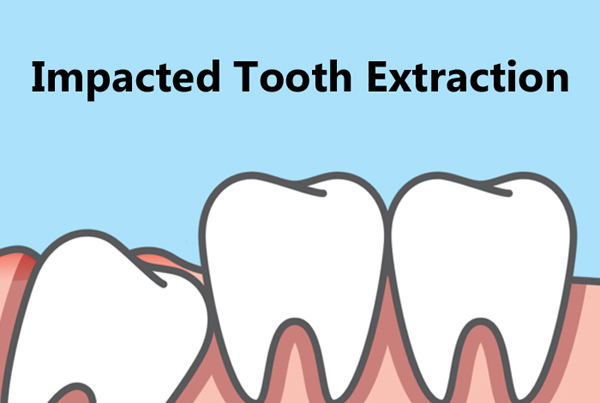 Impaction